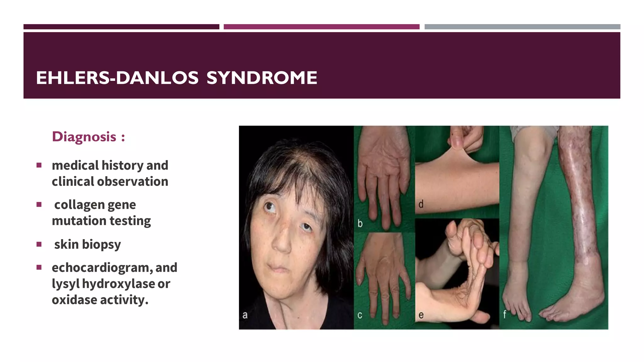 EHLERS-DANLOS SYNDROME
Diagnosis :
 medical history and
clinical observation
 collagen gene
mutation testing
 skin biopsy
 echocardiogram,and
lysyl hydroxylaseor
oxidase activity.
 
