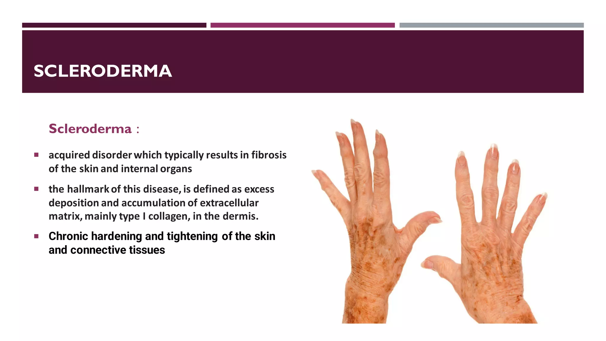 SCLERODERMA
Scleroderma :
 acquired disorderwhich typically results in fibrosis
of the skin and internal organs
 the hallmarkof this disease, is defined as excess
deposition and accumulation of extracellular
matrix, mainly type I collagen, in the dermis.
 Chronic hardening and tightening of the skin
and connective tissues
 