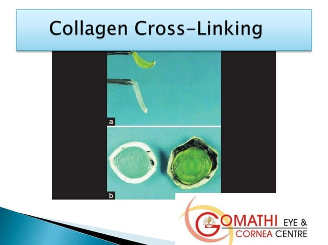 Collagen Cross Linking Cost | Keratoconus Corneal Cross-Linking ...