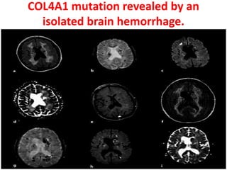 Collagen disorders in neurology | PPTX