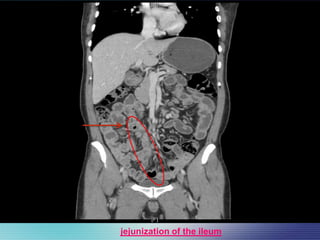 Case Presentation
jejunization of the ileum
 