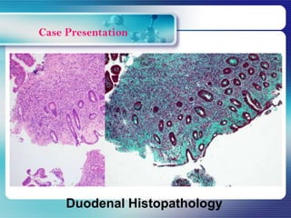 Duodenal Histopathology
 