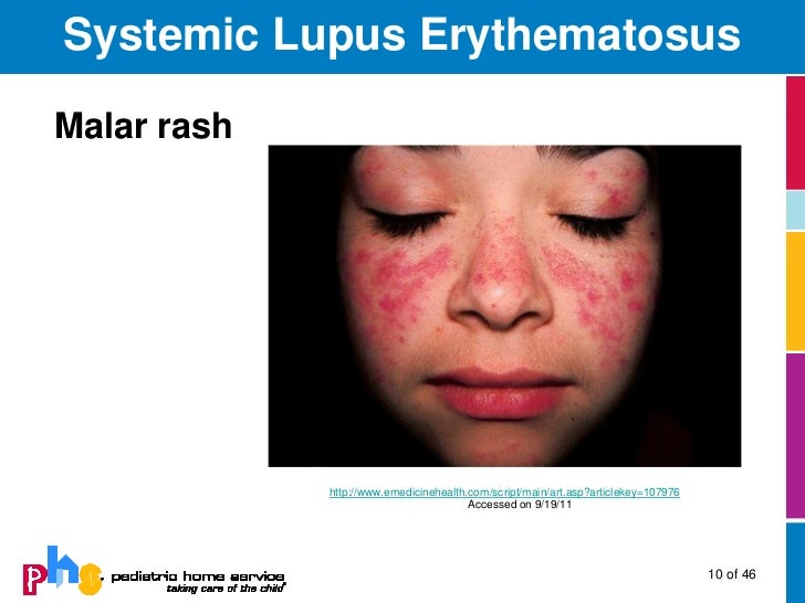 Collagen Vascular Disease in Children