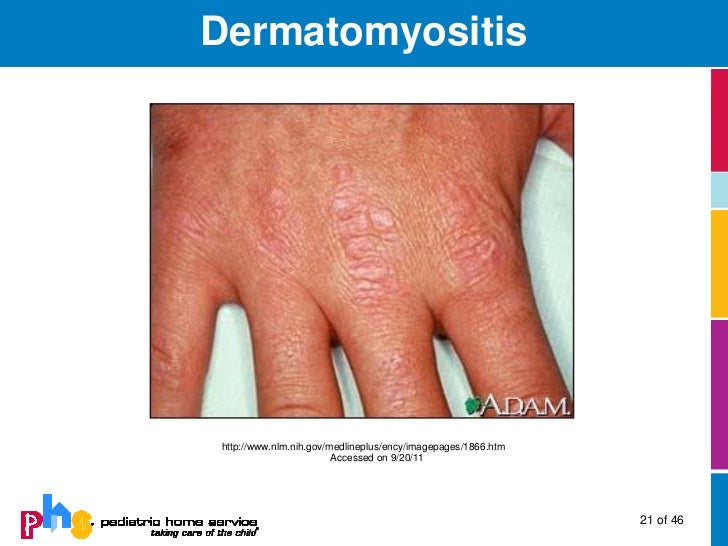 Collagen Vascular Disease in Children Collagen Vascular Disease in Children