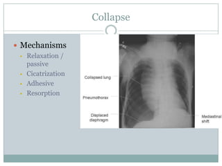 chest radiography: Collapse | PPTX