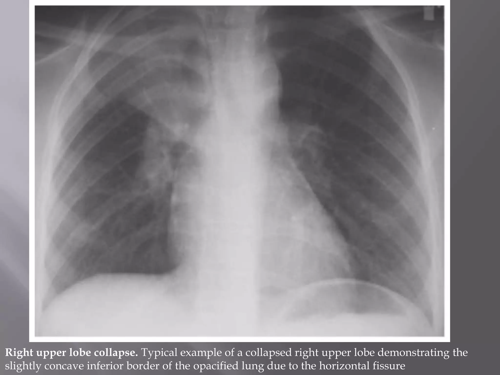 Right upper lobe collapse. Typical example of a collapsed right upper lobe demonstrating the
slightly concave inferior border of the opacified lung due to the horizontal fissure
 
