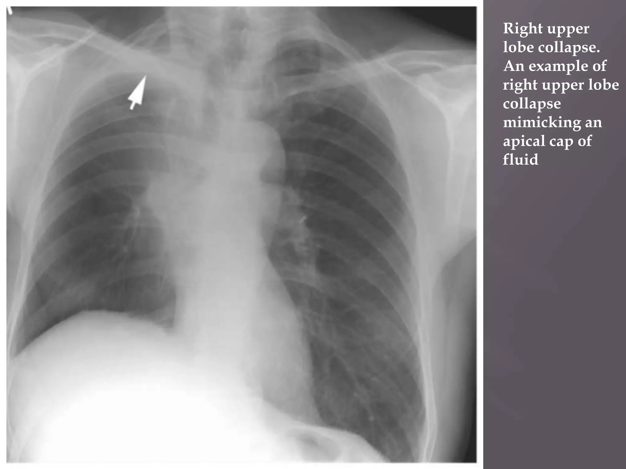  Right upper
lobe collapse.
An example of
right upper lobe
collapse
mimicking an
apical cap of
fluid
 