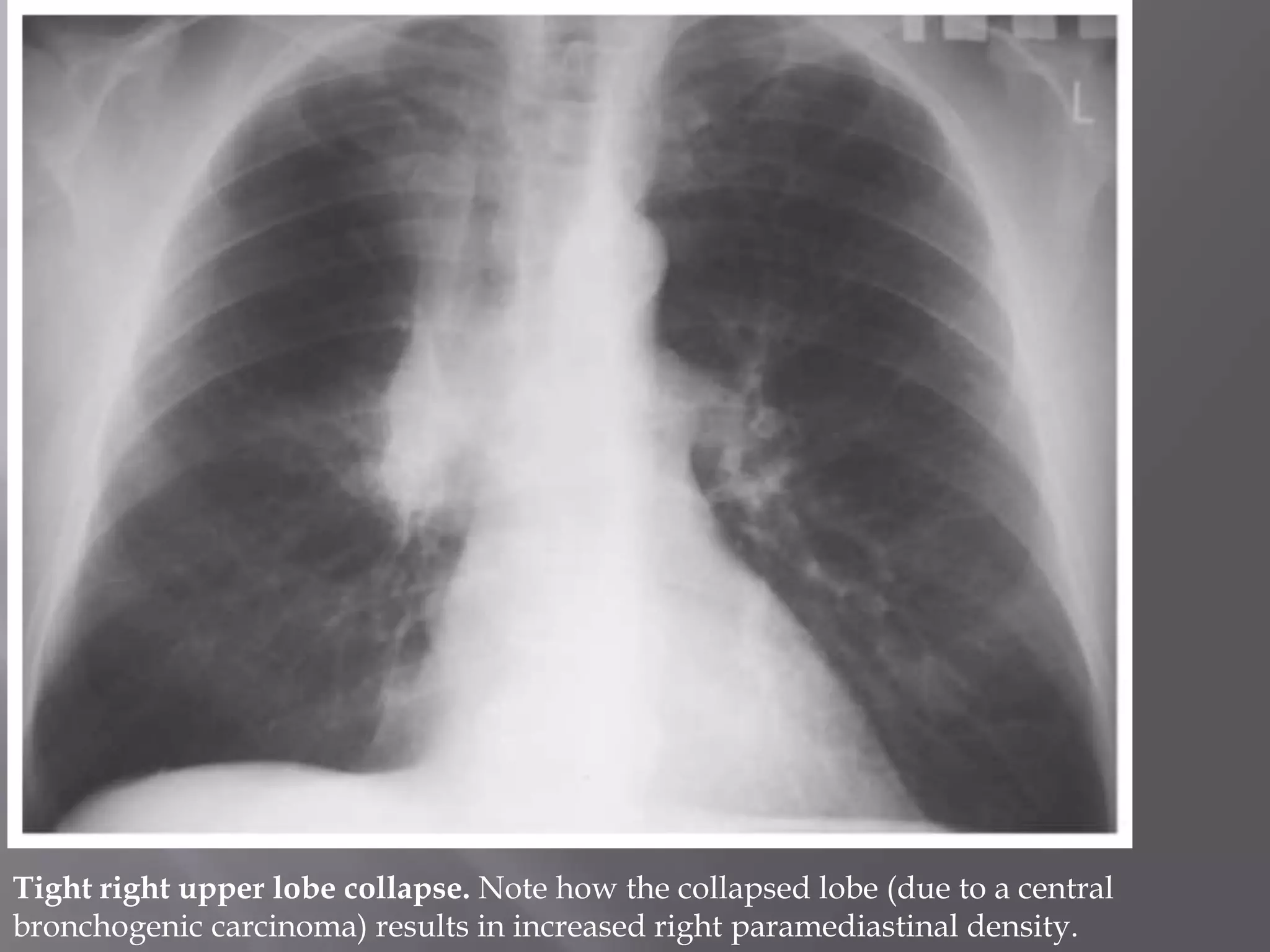 Tight right upper lobe collapse. Note how the collapsed lobe (due to a central
bronchogenic carcinoma) results in increased right paramediastinal density.
 