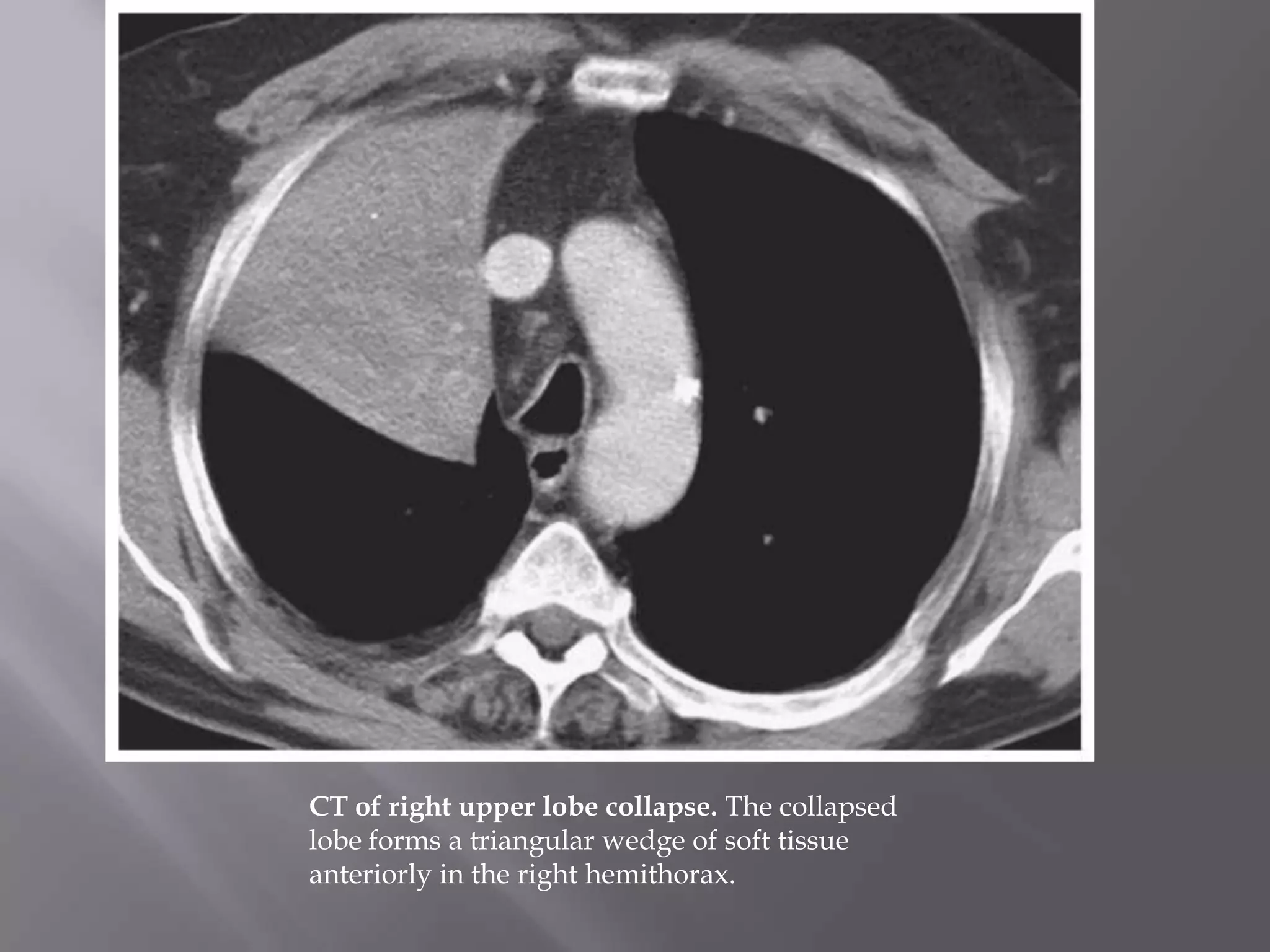 CT of right upper lobe collapse. The collapsed
lobe forms a triangular wedge of soft tissue
anteriorly in the right hemithorax.
 