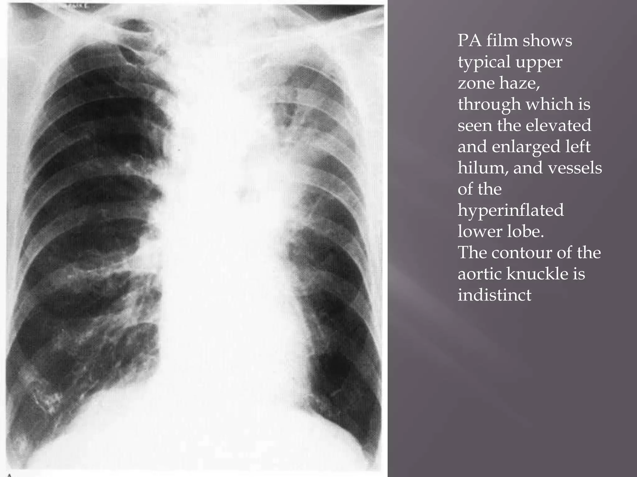 .
PA film shows
typical upper
zone haze,
through which is
seen the elevated
and enlarged left
hilum, and vessels
of the
hyperinflated
lower lobe.
The contour of the
aortic knuckle is
indistinct
 
