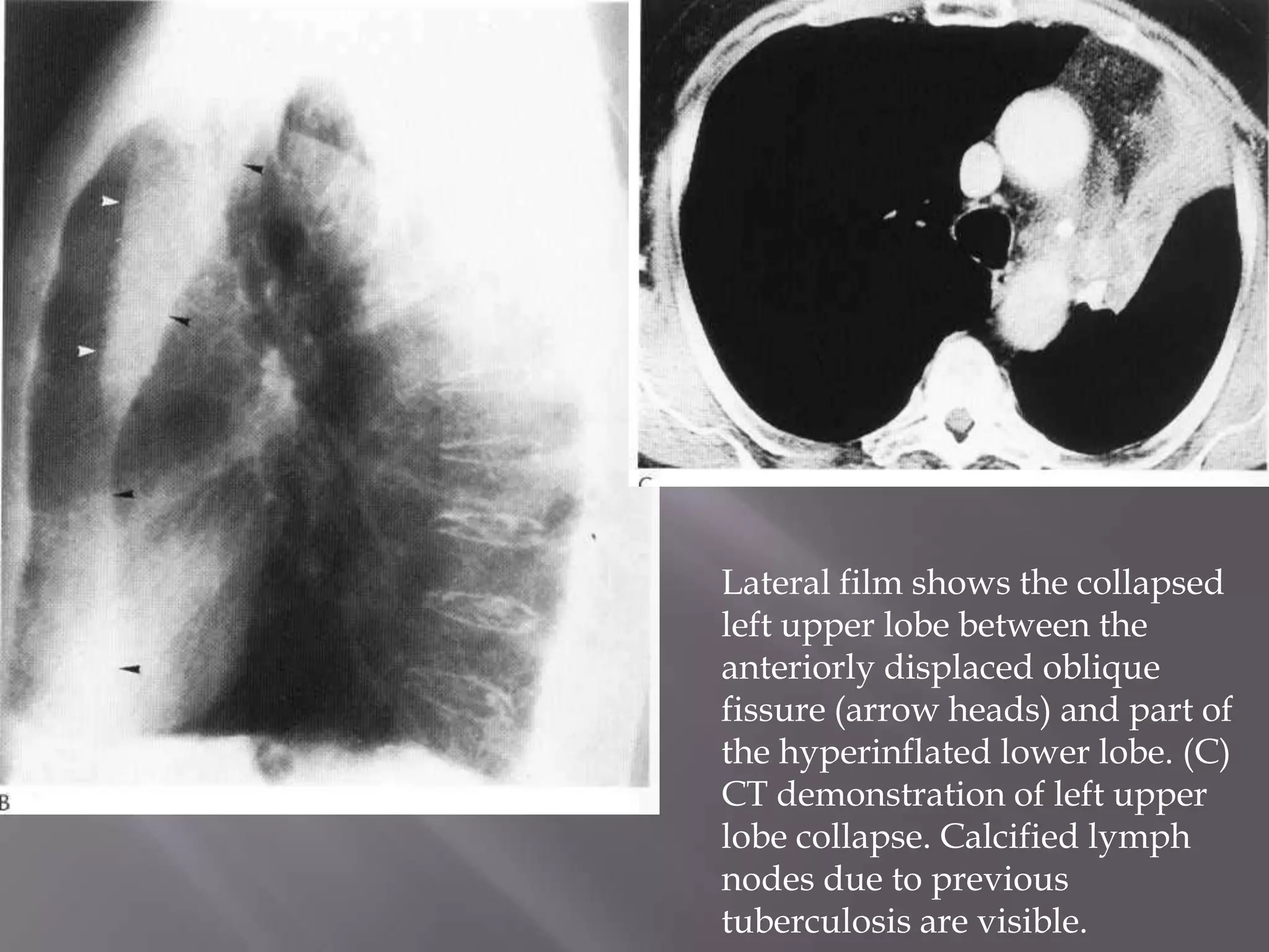 Lateral film shows the collapsed
left upper lobe between the
anteriorly displaced oblique
fissure (arrow heads) and part of
the hyperinflated lower lobe. (C)
CT demonstration of left upper
lobe collapse. Calcified lymph
nodes due to previous
tuberculosis are visible.
 