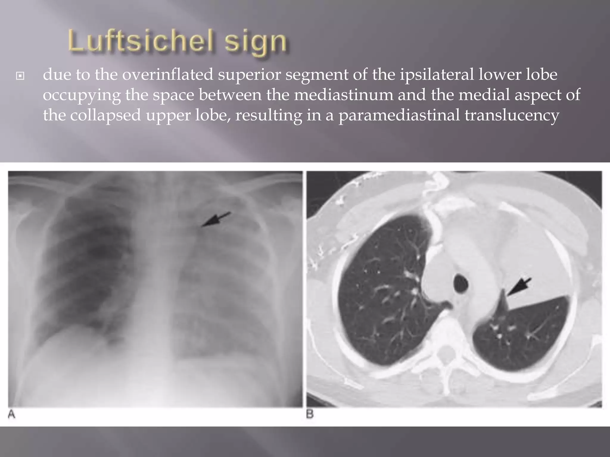  due to the overinflated superior segment of the ipsilateral lower lobe
occupying the space between the mediastinum and the medial aspect of
the collapsed upper lobe, resulting in a paramediastinal translucency
 
