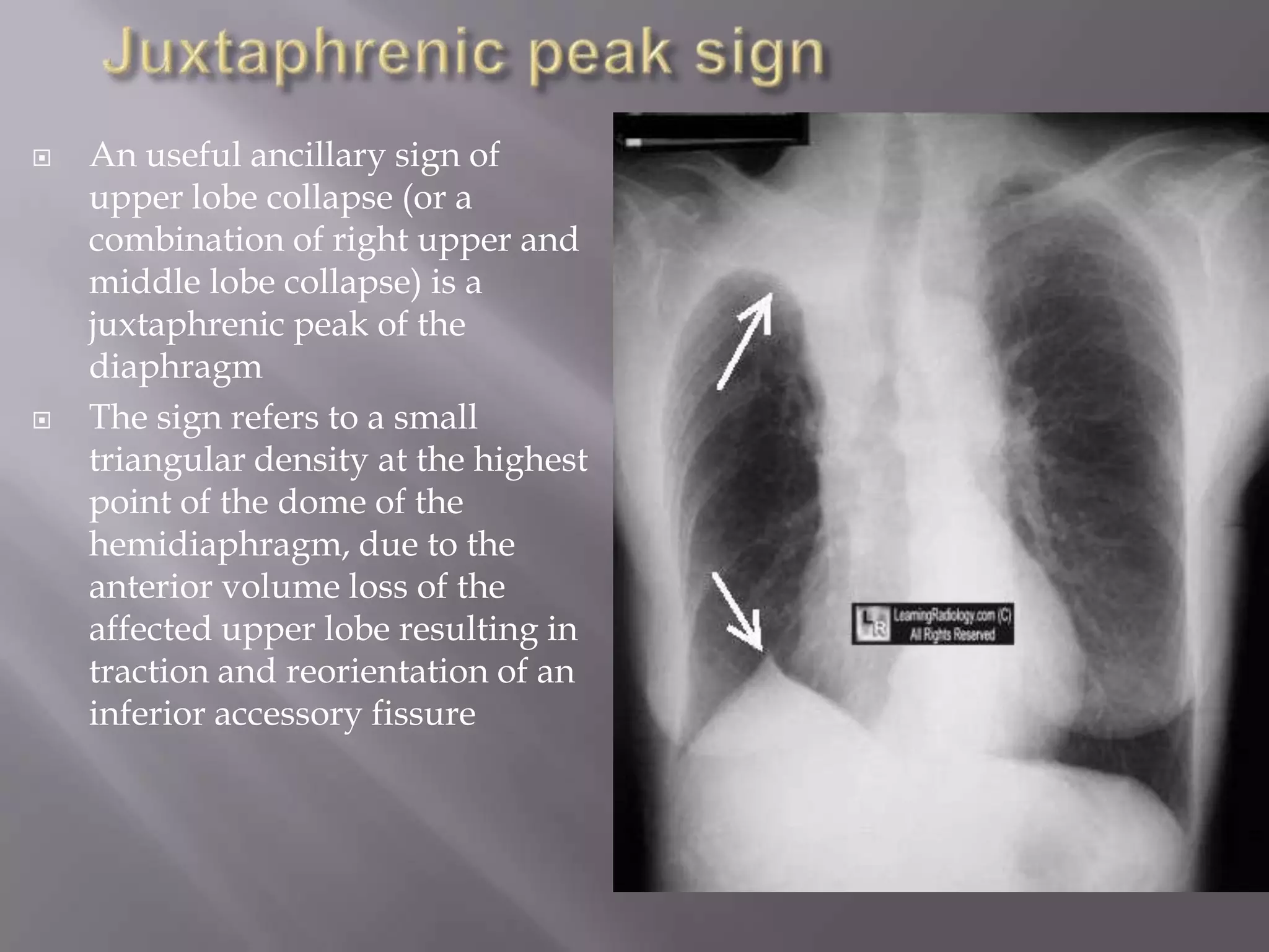  An useful ancillary sign of
upper lobe collapse (or a
combination of right upper and
middle lobe collapse) is a
juxtaphrenic peak of the
diaphragm
 The sign refers to a small
triangular density at the highest
point of the dome of the
hemidiaphragm, due to the
anterior volume loss of the
affected upper lobe resulting in
traction and reorientation of an
inferior accessory fissure
 