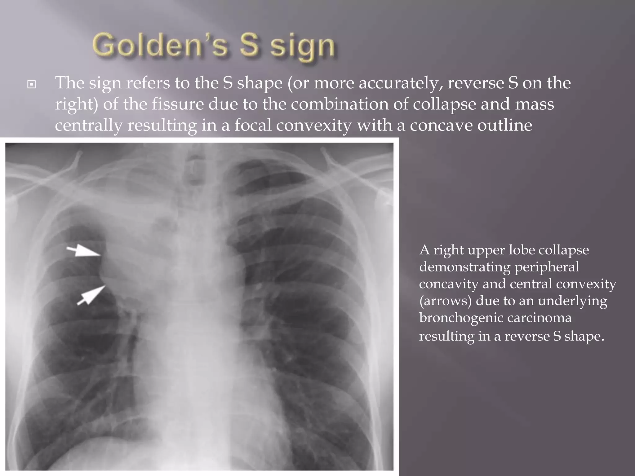  The sign refers to the S shape (or more accurately, reverse S on the
right) of the fissure due to the combination of collapse and mass
centrally resulting in a focal convexity with a concave outline
peripherally
A right upper lobe collapse
demonstrating peripheral
concavity and central convexity
(arrows) due to an underlying
bronchogenic carcinoma
resulting in a reverse S shape.
 