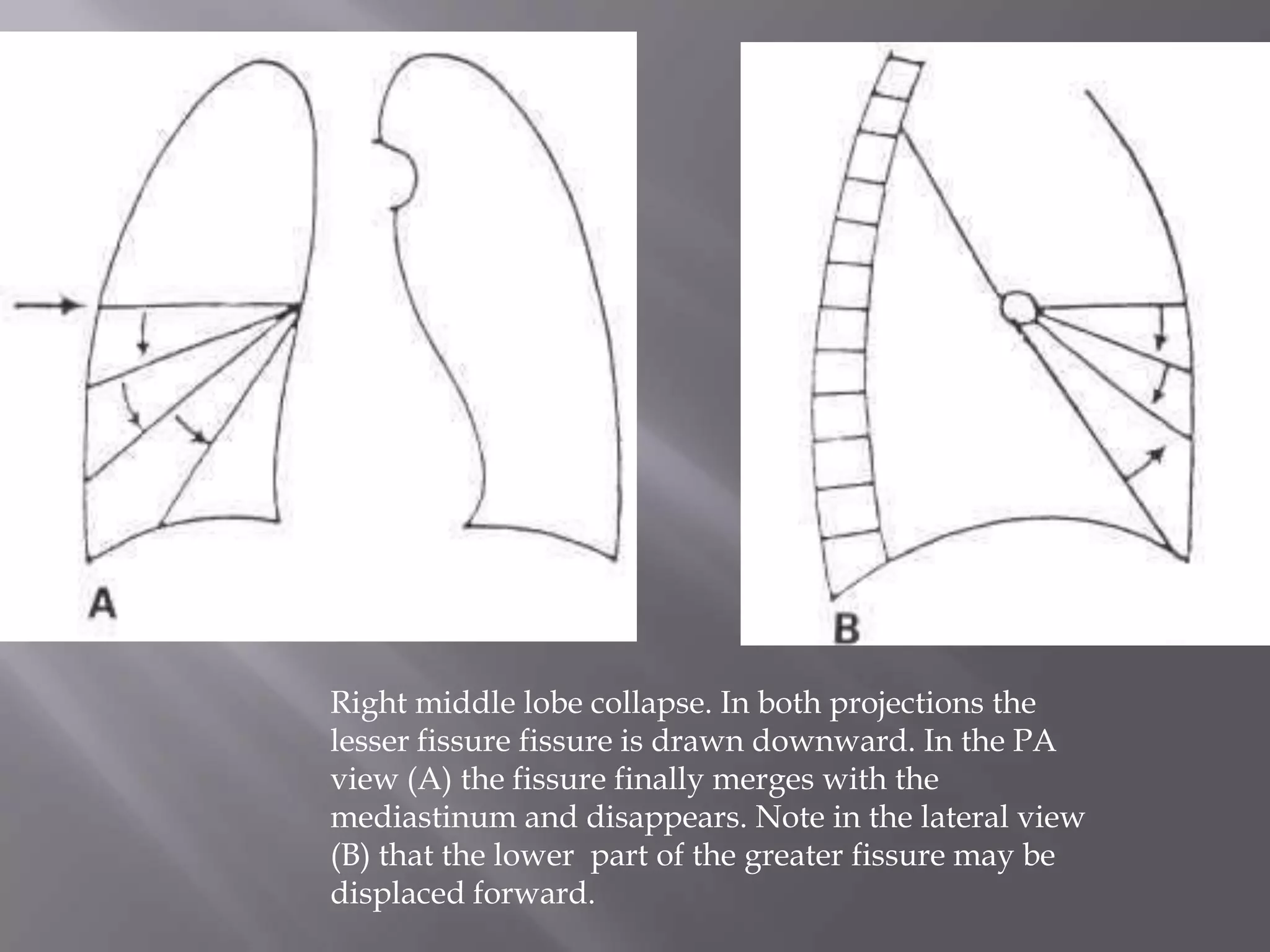 Right middle lobe collapse. In both projections the
lesser fissure fissure is drawn downward. In the PA
view (A) the fissure finally merges with the
mediastinum and disappears. Note in the lateral view
(B) that the lower part of the greater fissure may be
displaced forward.
 