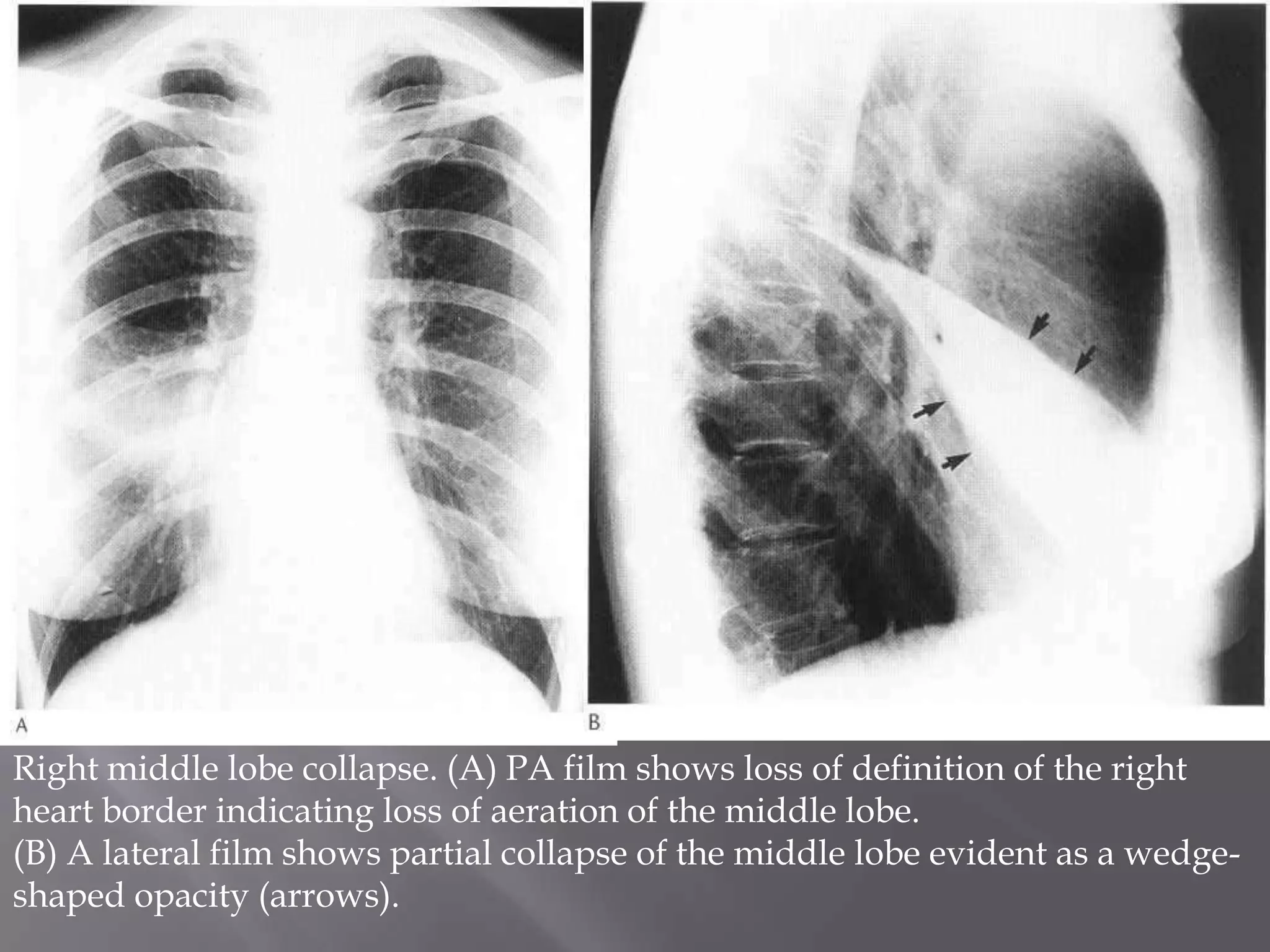 Right middle lobe collapse. (A) PA film shows loss of definition of the right
heart border indicating loss of aeration of the middle lobe.
(B) A lateral film shows partial collapse of the middle lobe evident as a wedge-
shaped opacity (arrows).
 