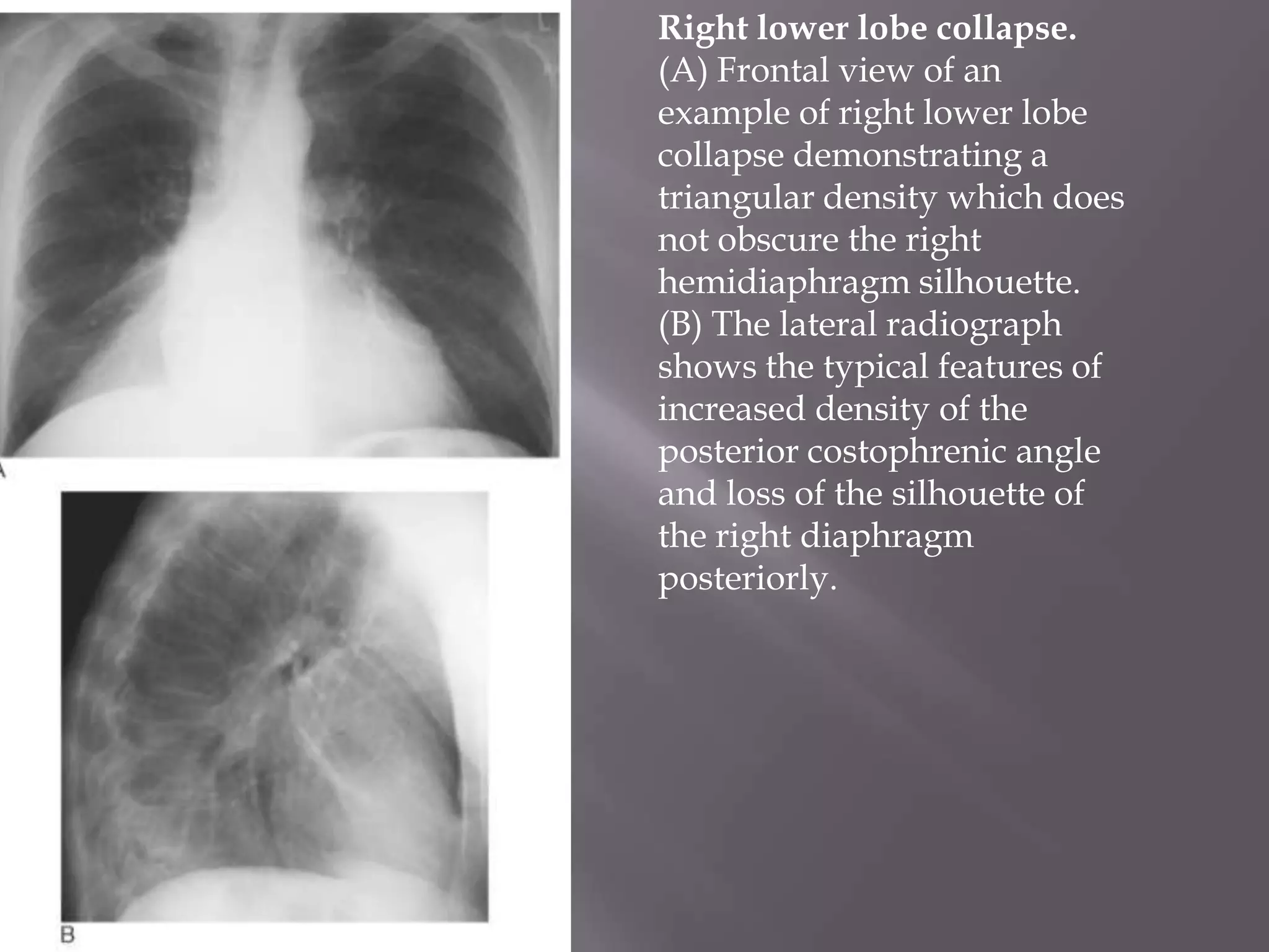 Right lower lobe collapse.
(A) Frontal view of an
example of right lower lobe
collapse demonstrating a
triangular density which does
not obscure the right
hemidiaphragm silhouette.
(B) The lateral radiograph
shows the typical features of
increased density of the
posterior costophrenic angle
and loss of the silhouette of
the right diaphragm
posteriorly.
 