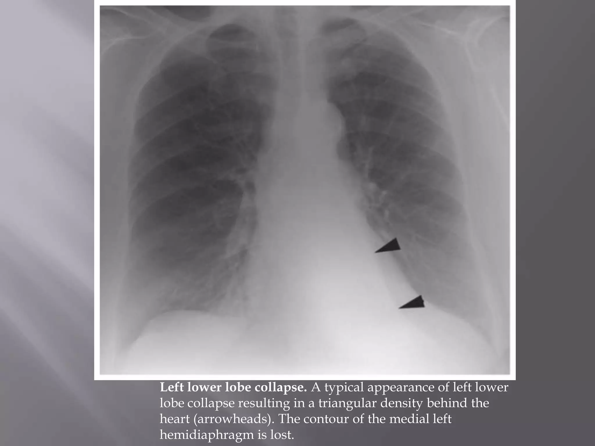 Left lower lobe collapse. A typical appearance of left lower
lobe collapse resulting in a triangular density behind the
heart (arrowheads). The contour of the medial left
hemidiaphragm is lost.
 