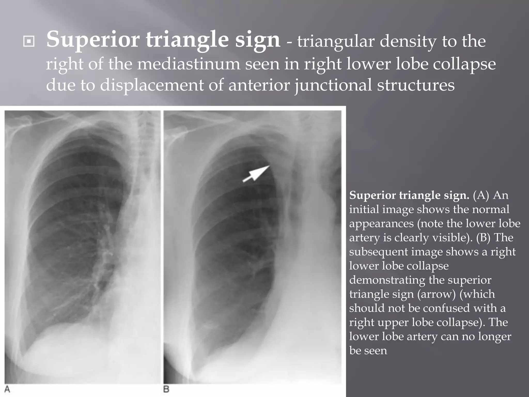  Superior triangle sign - triangular density to the
right of the mediastinum seen in right lower lobe collapse
due to displacement of anterior junctional structures
Superior triangle sign. (A) An
initial image shows the normal
appearances (note the lower lobe
artery is clearly visible). (B) The
subsequent image shows a right
lower lobe collapse
demonstrating the superior
triangle sign (arrow) (which
should not be confused with a
right upper lobe collapse). The
lower lobe artery can no longer
be seen
 