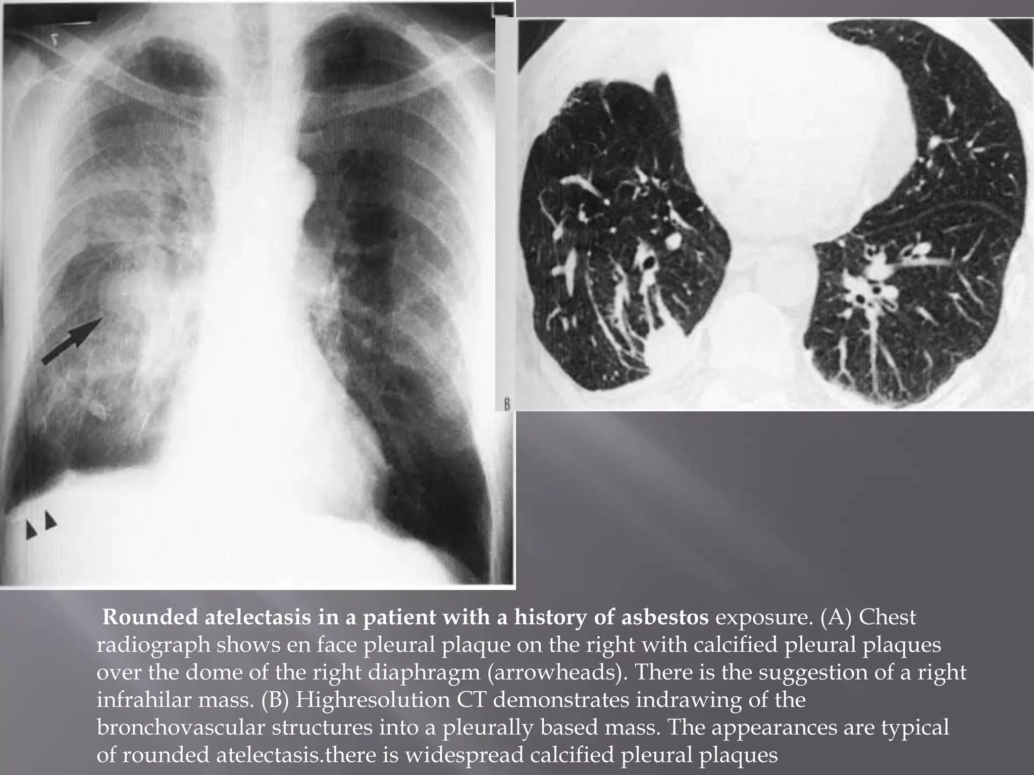 Rounded atelectasis in a patient with a history of asbestos exposure. (A) Chest
radiograph shows en face pleural plaque on the right with calcified pleural plaques
over the dome of the right diaphragm (arrowheads). There is the suggestion of a right
infrahilar mass. (B) Highresolution CT demonstrates indrawing of the
bronchovascular structures into a pleurally based mass. The appearances are typical
of rounded atelectasis.there is widespread calcified pleural plaques
 