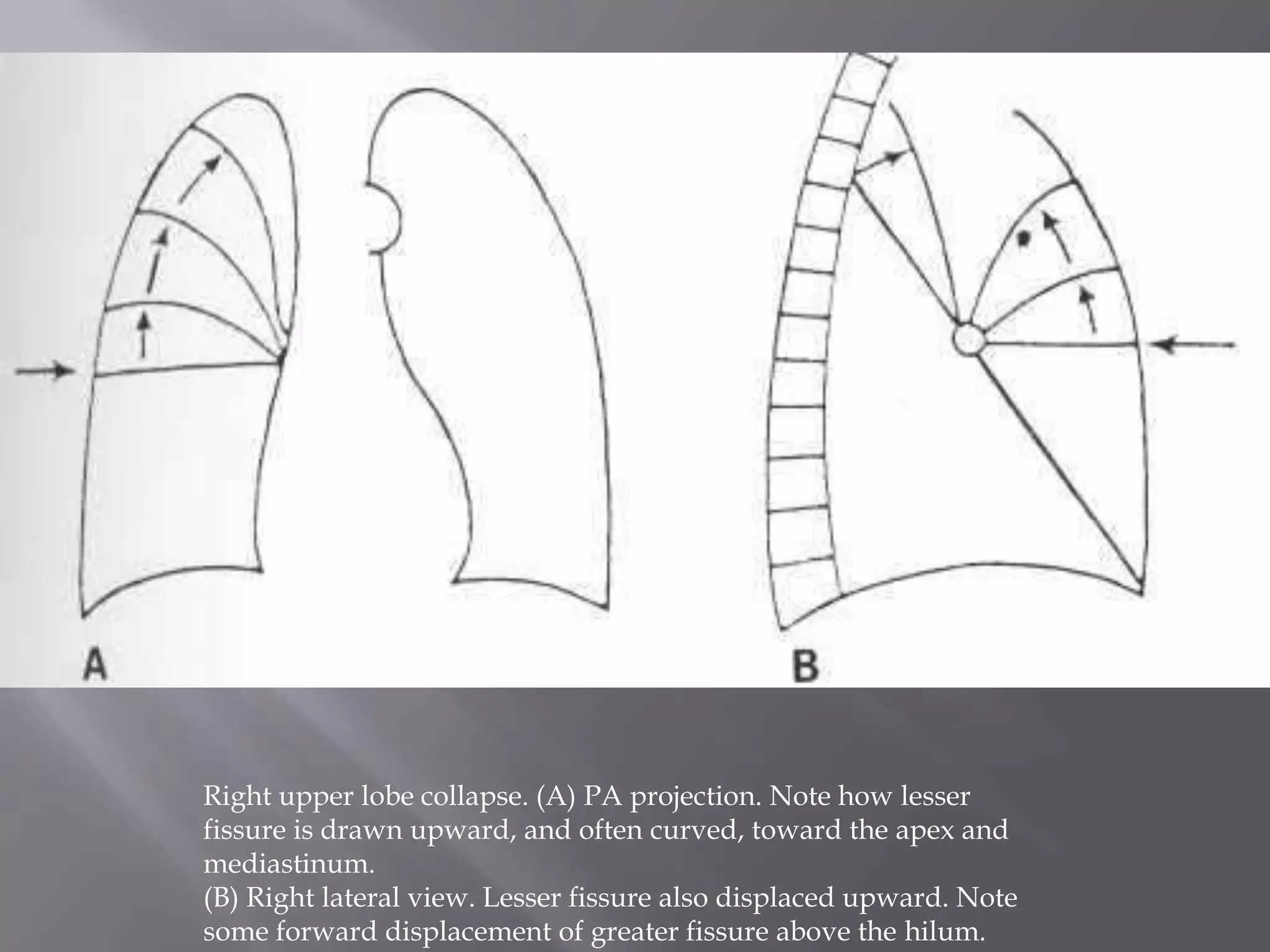 Right upper lobe collapse. (A) PA projection. Note how lesser
fissure is drawn upward, and often curved, toward the apex and
mediastinum.
(B) Right lateral view. Lesser fissure also displaced upward. Note
some forward displacement of greater fissure above the hilum.
 