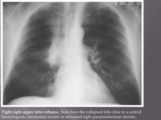 Tight right upper lobe collapse. Note how the collapsed lobe (due to a central
bronchogenic carcinoma) results in increased right paramediastinal density.
 