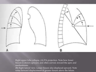 Right upper lobe collapse. (A) PA projection. Note how lesser
fissure is drawn upward, and often curved, toward the apex and
mediastinum.
(B) Right lateral view. Lesser fissure also displaced upward. Note
some forward displacement of greater fissure above the hilum.
 