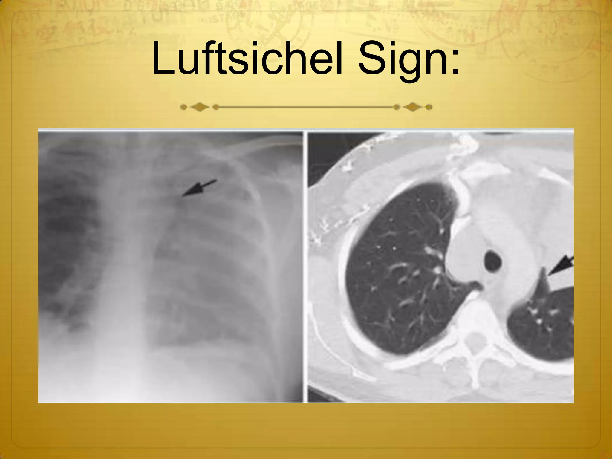 Luftcycle Sign Collapse & consolidation made simple - chest X-rayz | PPTX