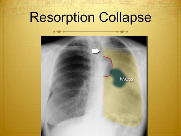 Collapse & consolidation made simple - chest X-rayz | PPTX | Lung and ...