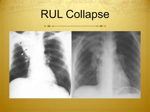Collapse & consolidation made simple - chest X-rayz | PPTX | Lung and ...