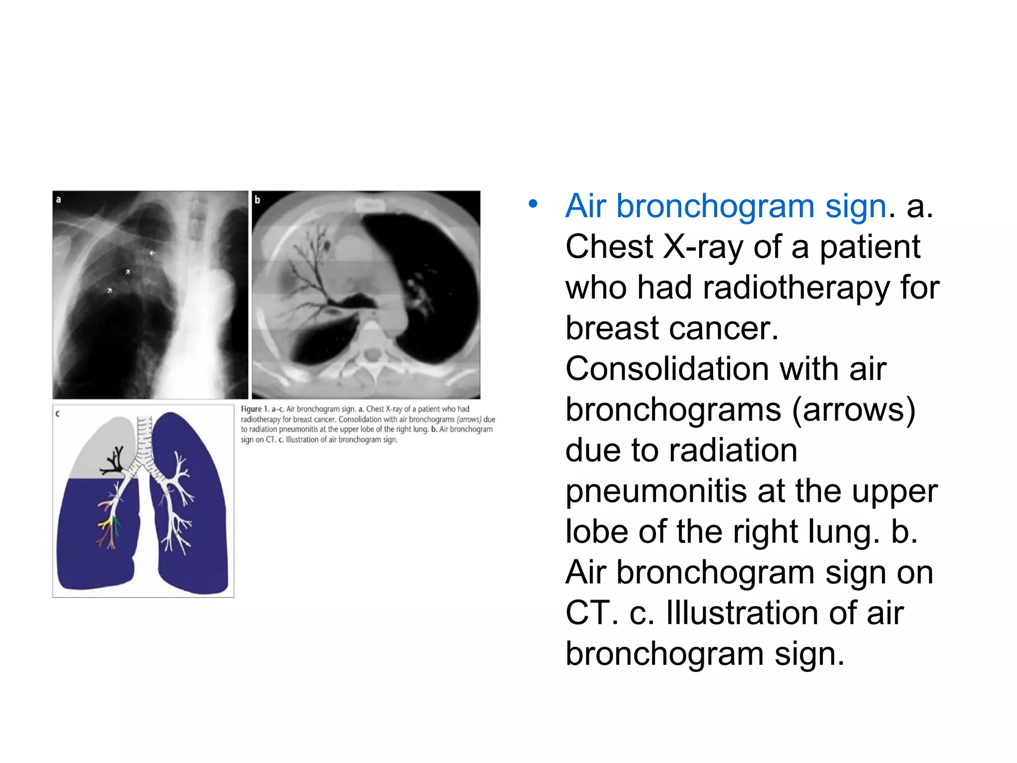 Collapse and consolidation Lung Radiology | PPT