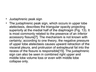 • Juxtaphrenic peak sign
• The juxtaphrenic peak sign, which occurs in upper lobe
atelectasis, describes the triangular opacity projecting
superiorly at the medial half of the diaphragm (Fig. 13). It
is most commonly related to the presence of an inferior
accessory fissure[7]. The mechanism is not known with
certainty; according to one theory, the negative pressure
of upper lobe atelectasis causes upward retraction of the
visceral pleura, and protrusion of extrapleural fat into the
recess of the fissure is responsible[15]. The juxtaphrenic
sign can also be seen in combined right upper and
middle lobe volume loss or even with middle lobe
collapse only.

 