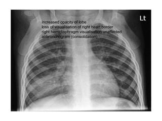 increased opacity of lobe
loss of visualisation of right heart border
right hemidiaphragm visualisation unaffected
airbronchogram (consolidation)

 