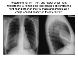 Posteroanterior (PA) (left) and lateral chest (right)
radiographs. A right middle lobe collapse obliterates the
right heart border on the PA image and projects as a
wedge-shaped opacity on the lateral view.

 