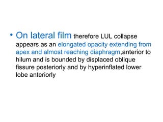 • On lateral film therefore LUL collapse
appears as an elongated opacity extending from
apex and almost reaching diaphragm,anterior to
hilum and is bounded by displaced oblique
fissure posteriorly and by hyperinflated lower
lobe anteriorly

 
