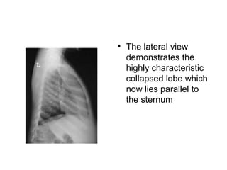 • The lateral view
demonstrates the
highly characteristic
collapsed lobe which
now lies parallel to
the sternum

 