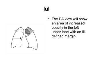 lul
• The PA view will show
an area of increased
opacity in the left
upper lobe with an illdefined margin.

 