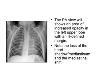 • The PA view will
shows an area of
increased opacity in
the left upper lobe
with an ill-defined
margin.
• Note the loss of the
heart
shadow/mediastinum
and the mediastinal
shift

 