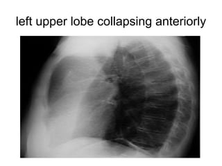 left upper lobe collapsing anteriorly

 