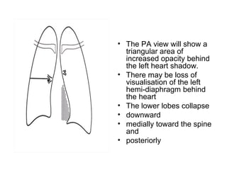 • The PA view will show a
triangular area of
increased opacity behind
the left heart shadow.
• There may be loss of
visualisation of the left
hemi-diaphragm behind
the heart
• The lower lobes collapse
• downward
• medially toward the spine
and
• posteriorly

 