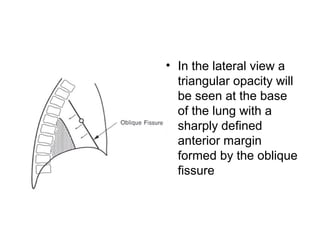 • In the lateral view a
triangular opacity will
be seen at the base
of the lung with a
sharply defined
anterior margin
formed by the oblique
fissure

 