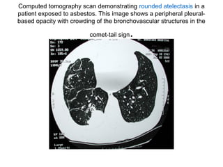 Computed tomography scan demonstrating rounded atelectasis in a
patient exposed to asbestos. This image shows a peripheral pleuralbased opacity with crowding of the bronchovascular structures in the
comet-tail sign

.

 