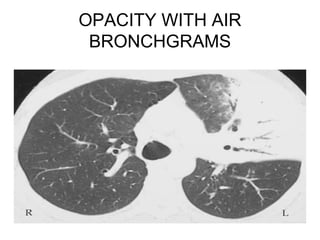 OPACITY WITH AIR
BRONCHGRAMS

 