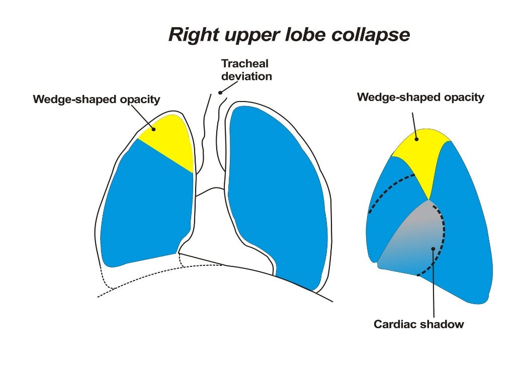Collapse and consolidation Lung Radiology