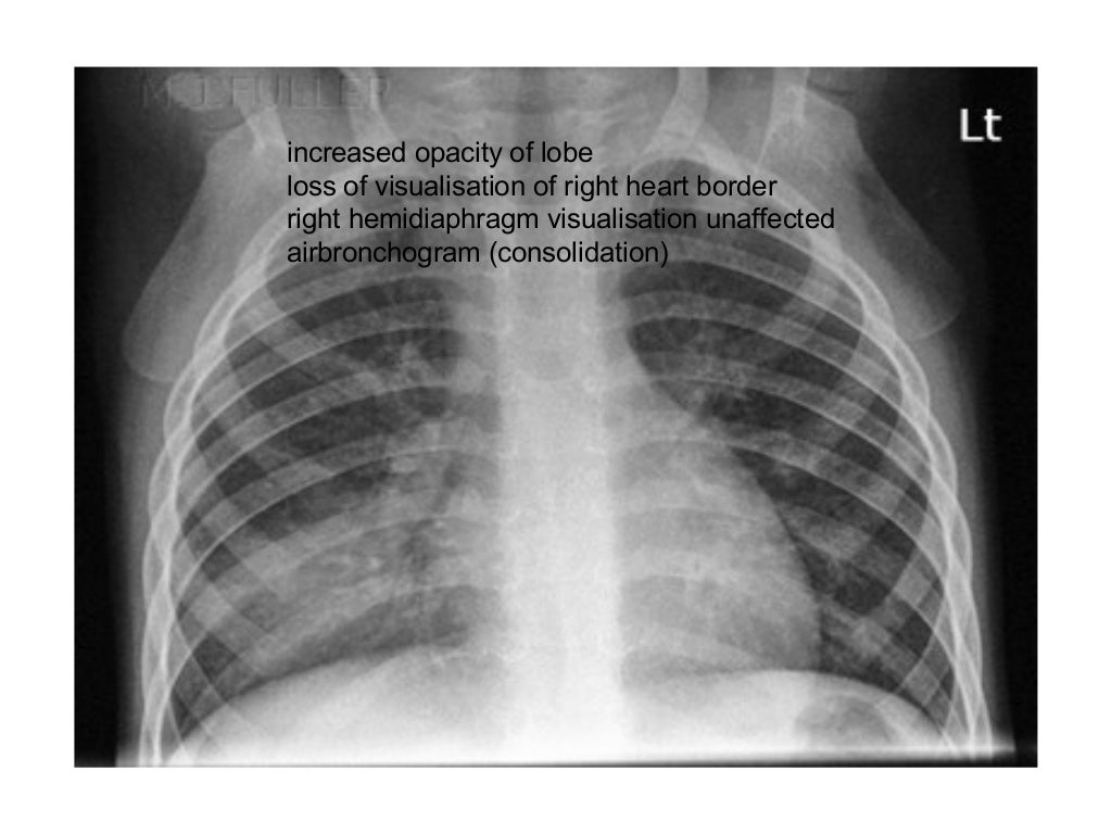 Collapse and consolidation Lung Radiology