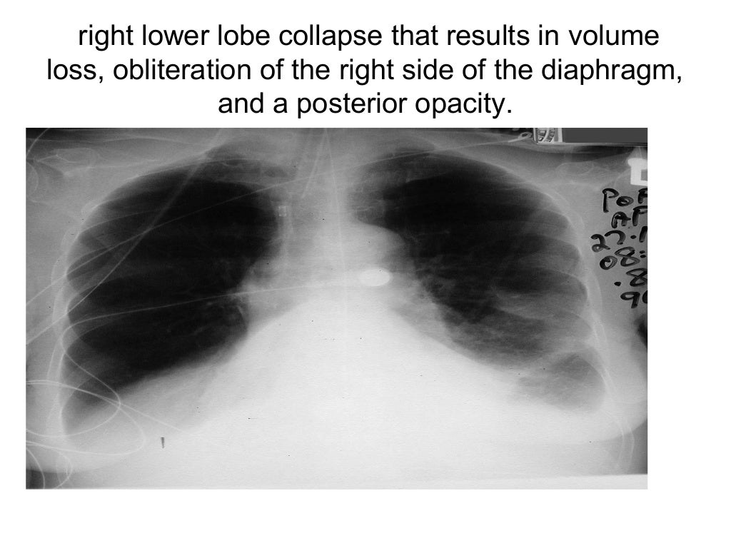 Collapse and consolidation Lung Radiology