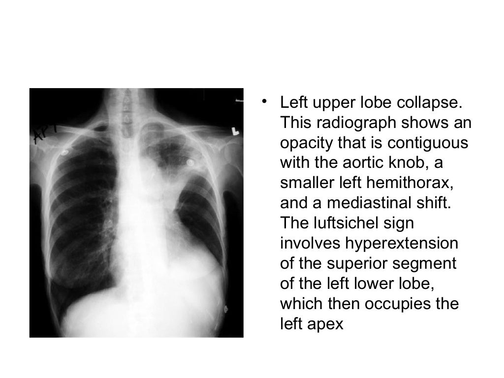 Collapse and consolidation Lung Radiology
