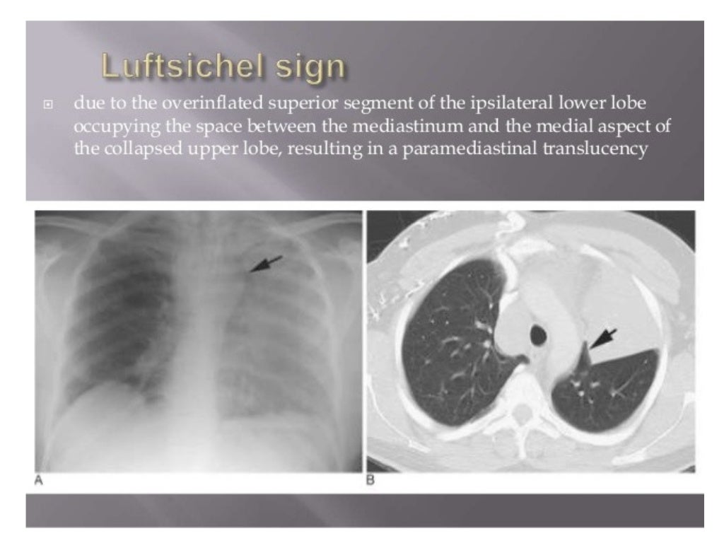 Collapse and consolidation Lung Radiology
