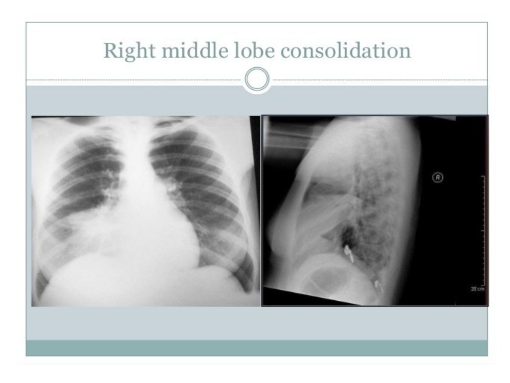 Collapse and consolidation Lung Radiology