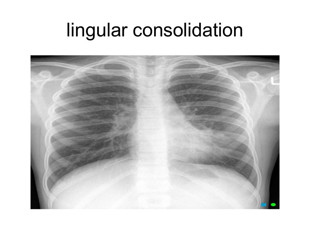 Collapse and consolidation Lung Radiology